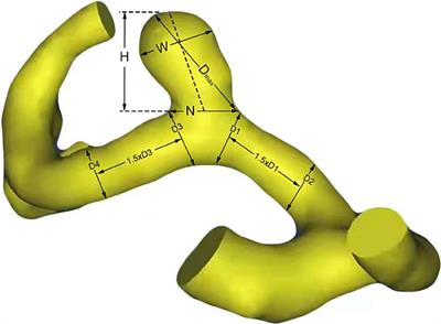 Morphological and Hemodynamic Risk Factors for the Rupture of Proximal Anterior Cerebral Artery Aneurysms (A1 Segment)